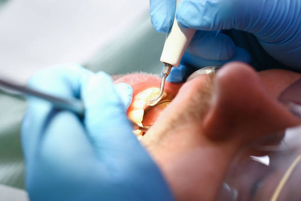 Best Emergency Root Canal Treatment in Martins Additions, MD